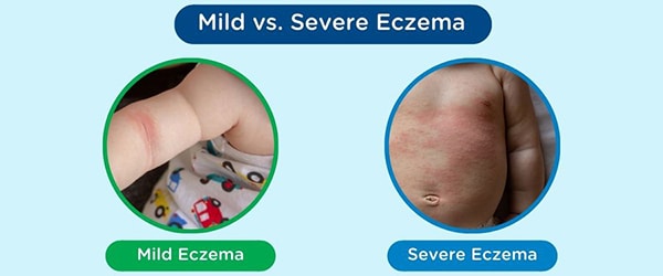 Two pictures comparing mild and severe signs of an allergic reaction